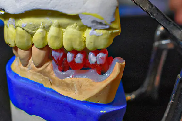 نمونه کارهای لابراتوار دندانسازی های دنت