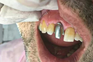 نمونه کارهای لابراتوار دندانسازی های دنت