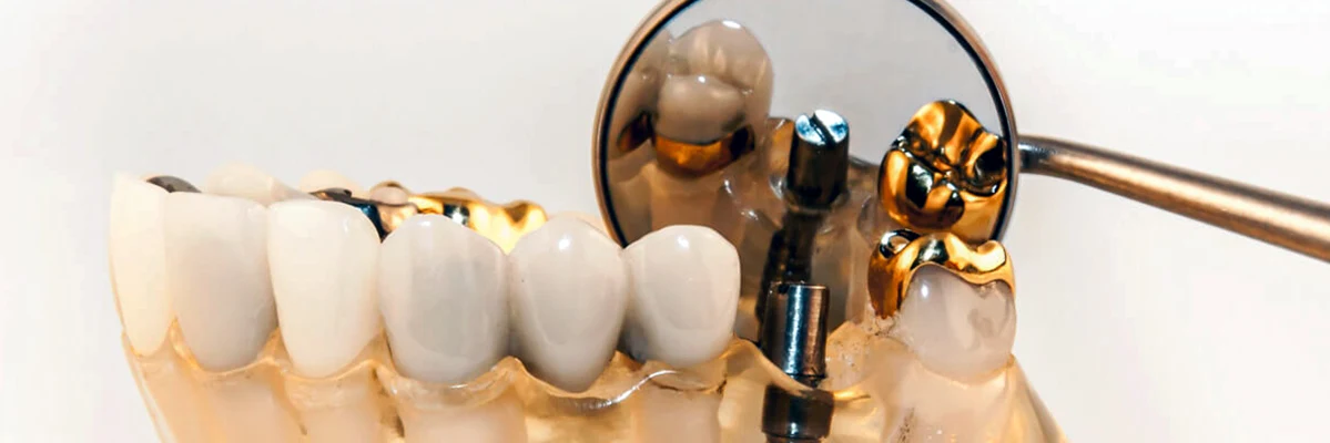 آموزش دندانسازی روکش دندان طلا