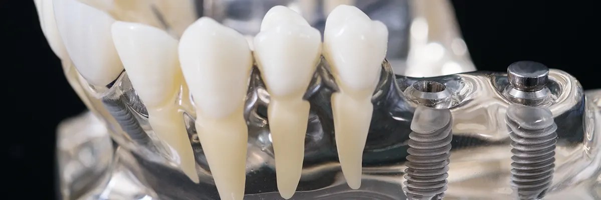 دلیل استفاده از ایمپلنت دندان چیست؟