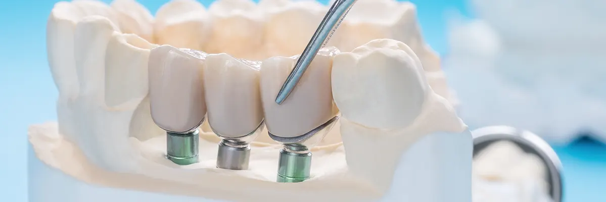 مراحل ایمپلنت دندان و نحوۀ قرار دادن آن