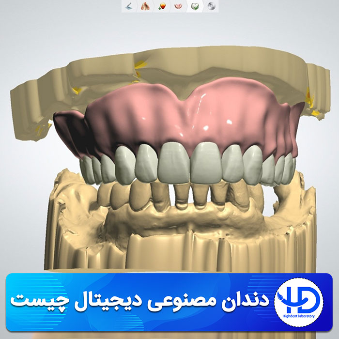 دندان مصنوعی دیجیتال چیست