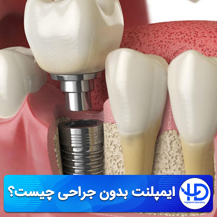 ایمپلنت بدون جراحی چیست