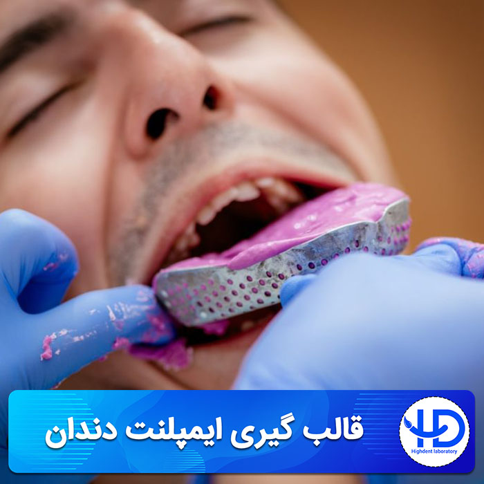 قالب گیری ایمپلنت دندان