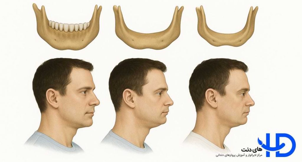 تحلیل استخوان فک