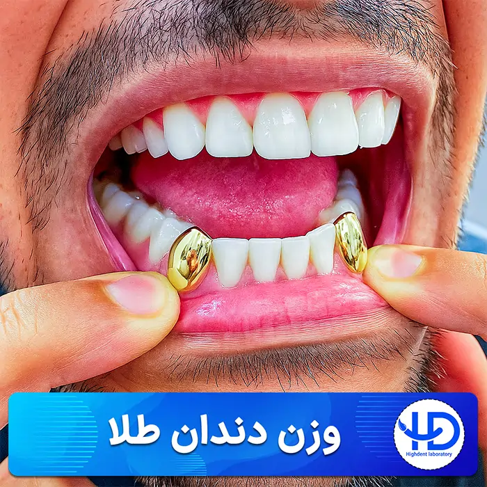 وزن دندان طلا