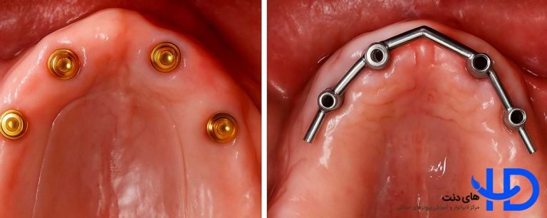 اتصال اوردنچر به فک