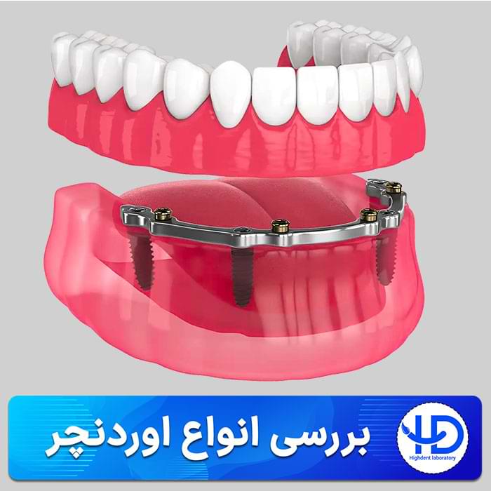 بررسی انواع اوردنچر