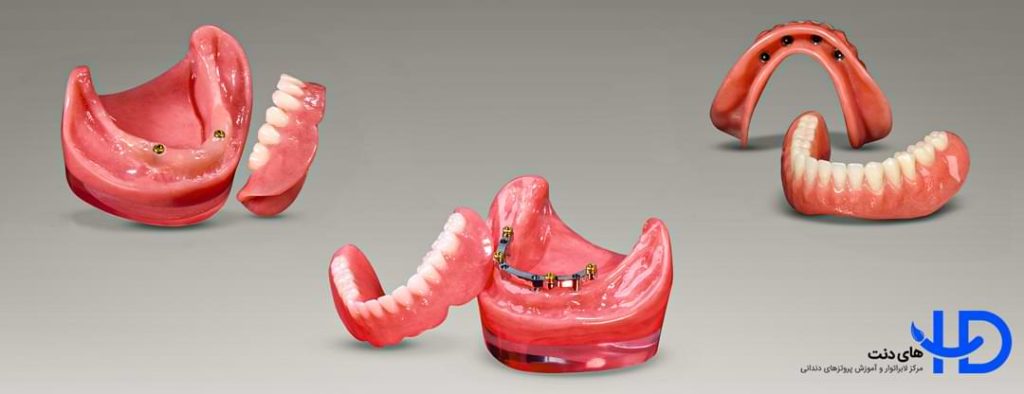 تعداد ایمپلنت لازم برای انواع اوردنچر