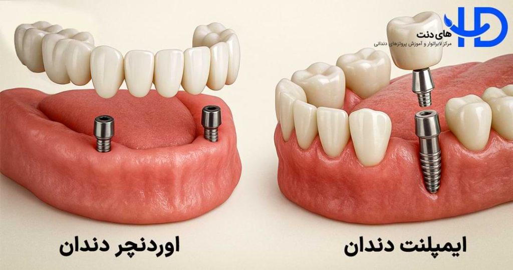 تفاوت اوردنچر با ایمپلنت