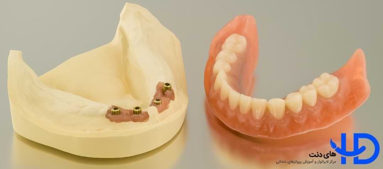 هزینه دست دندان کامل اوردنچر