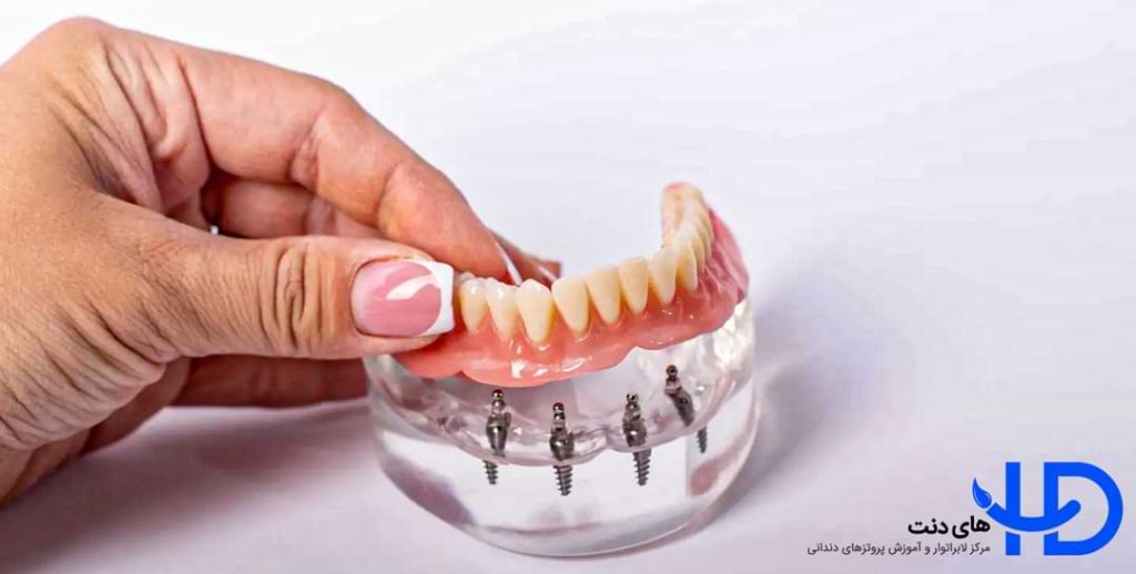 مشکلات اوردنچر دندان