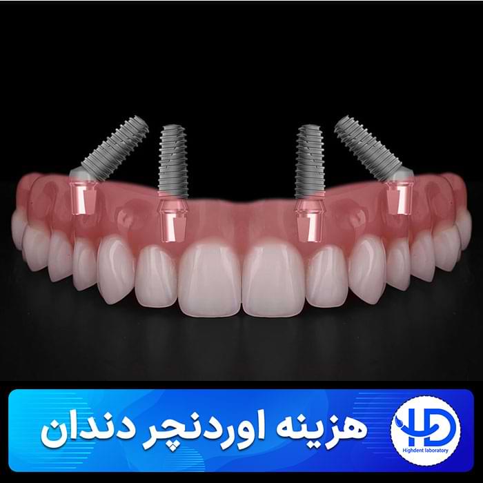 هزینه اوردنچر دندان چقدر است