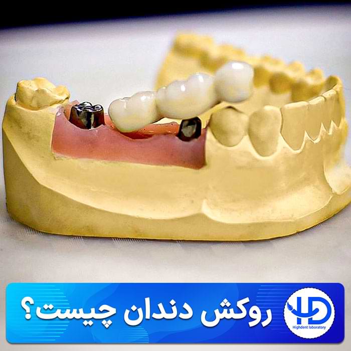 روکش دندان چیست؟​